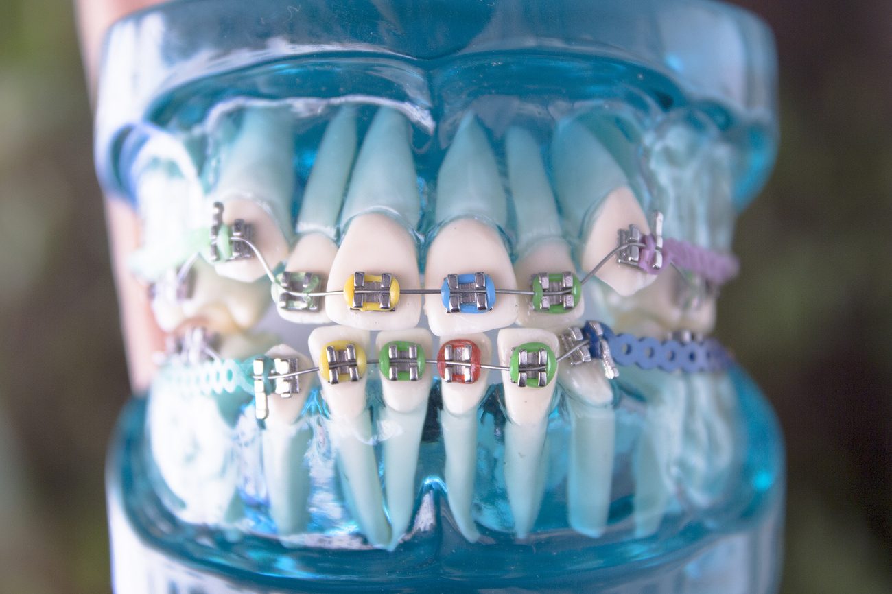Close-up of an orthodontic teeth model with metal braces and colorful elastic bands